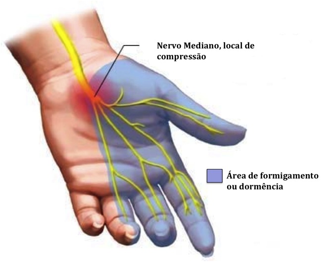 Locais atingidos pela síndrome do túnel do carpo 